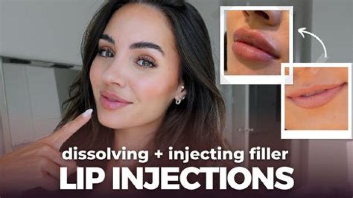 Amanda Stanton Gets Lip Injections on Instagram and Fans Kind of Hate It