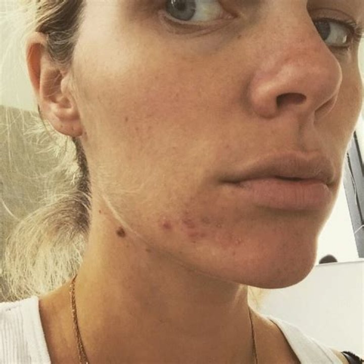 Brooklyn Decker Shares Makeup Free Selfie — Admits Pregnancy Hormones Give Her Acne and a Hairy Face!