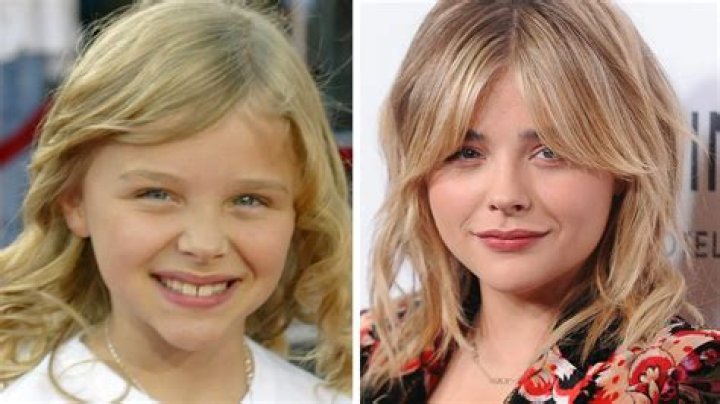 Chloe Grace Moretz’s Plastic Surgery: The Untold Truth!