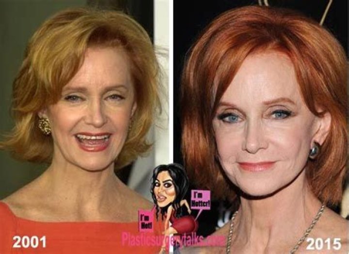 Has Swoosie Kurtz Done Plastic surgery For Face Lift And Jawline? Her Before And After Photos Explored