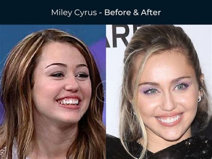 
Mackenzie Scott Teeth Before And After; Has American Novelist Has Done A Surgery? 
