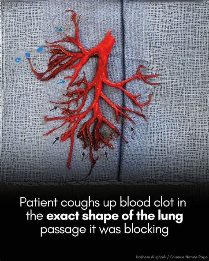 Man Coughs Up Blood Clot In The Exact Shape Of His Lung Passage