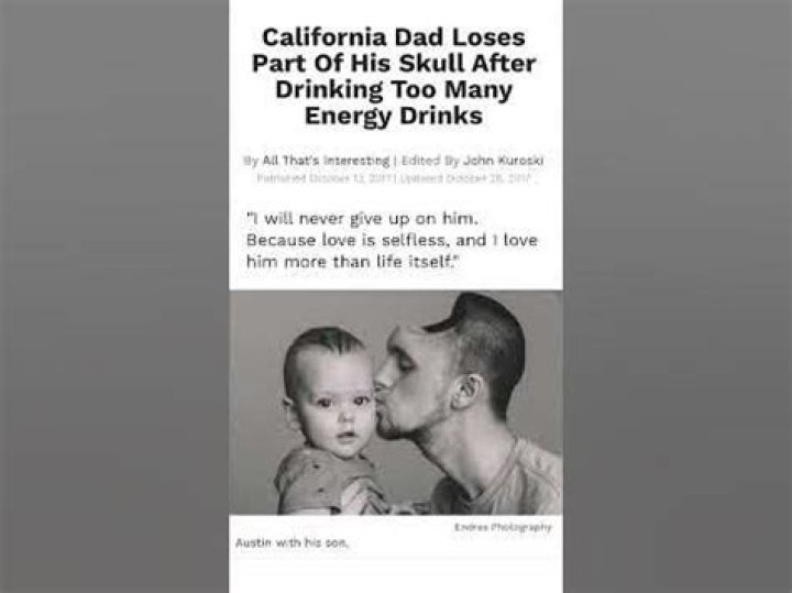 Man Loses Part Of His Skull After Drinking Too Many Energy Drinks
