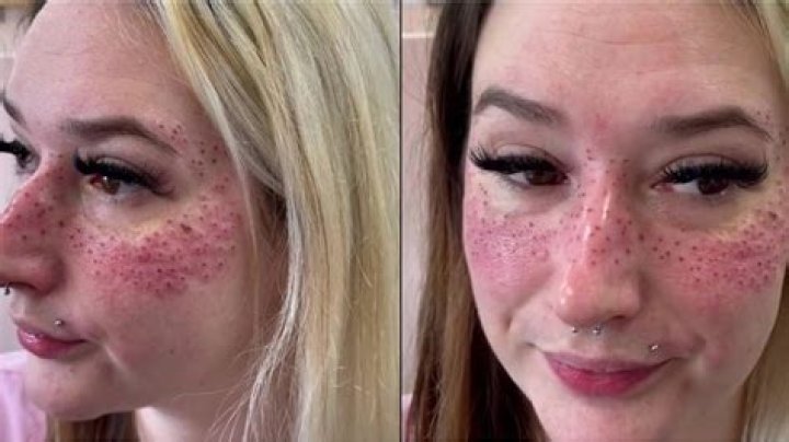 People Are Literally Tattooing Their Faces to Get Freckles