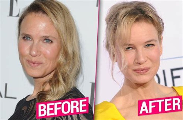 Plastic Surgery?See Reneé Zellweger’s Shocking Transformation Right Before Your Eyes