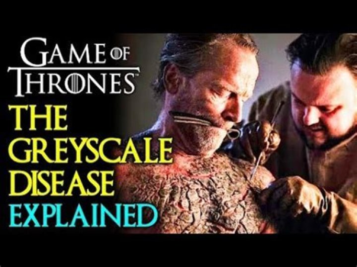 What is greyscale disease in ‘Game of Thrones’? What causes it and is it a real-life disease?