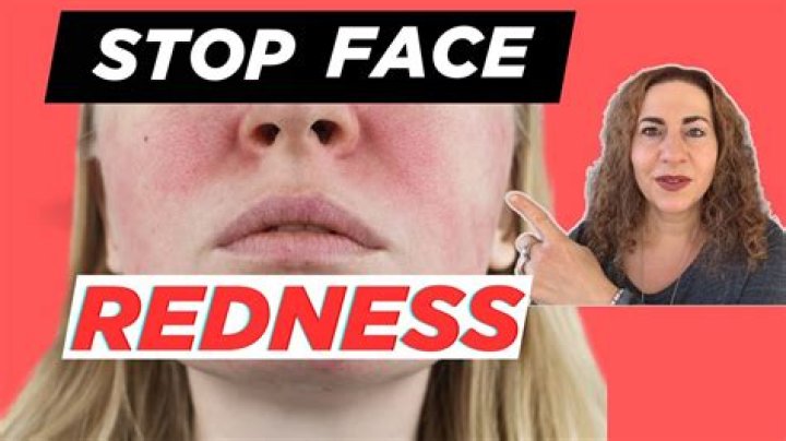 When did Dale’s nose turn red? – Celebrity.fm – #1 Official Stars, Business & People Network, Wiki, Success story, Biography & Quotes